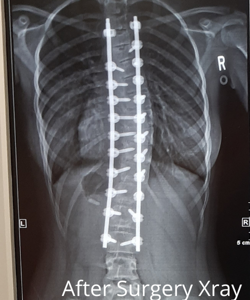 Xray showing a straightened spine with metal rods screwed into the vertebrae