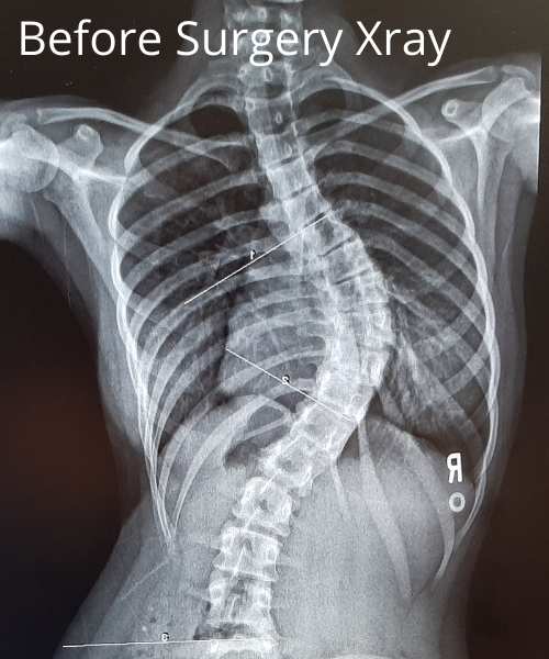 Xray showing large curve in spine from scoliosis